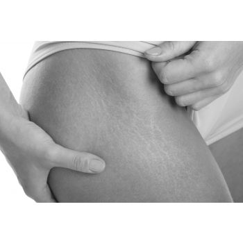 Stretch Marks - Tchabo MedSpa